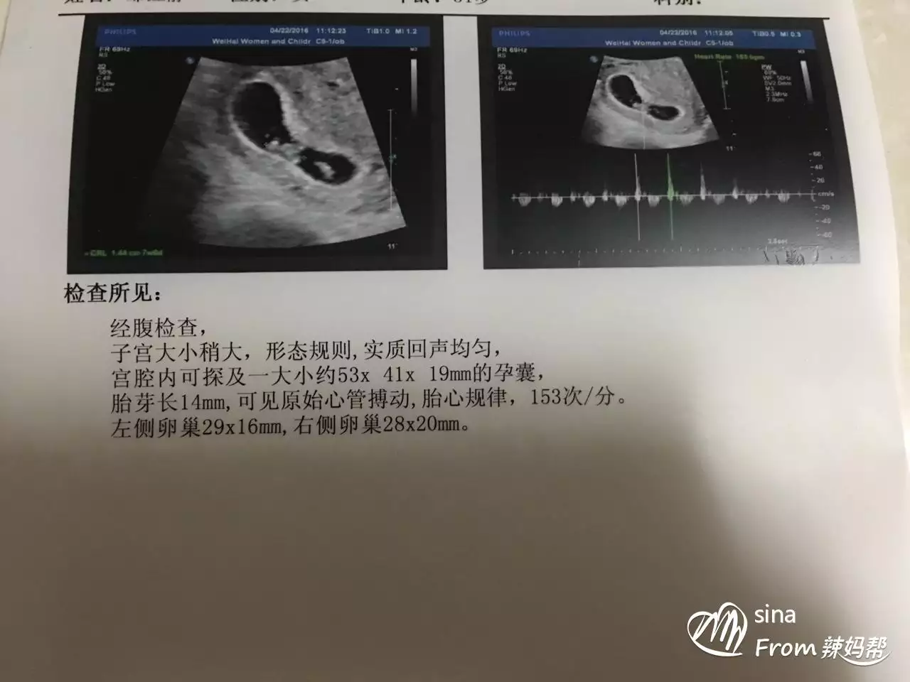6一7周孕囊大小看男女准嗎：可以根據胚胎的形態判斷男孩女孩嗎