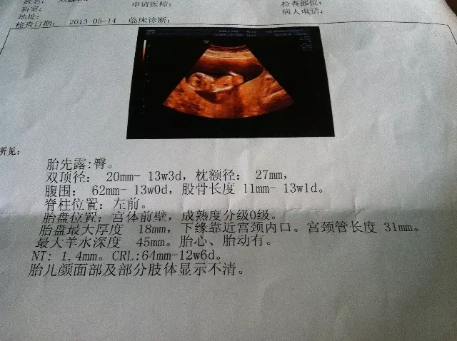 懷孕幾個月能看出男女最准：最快幾個月能查出男女