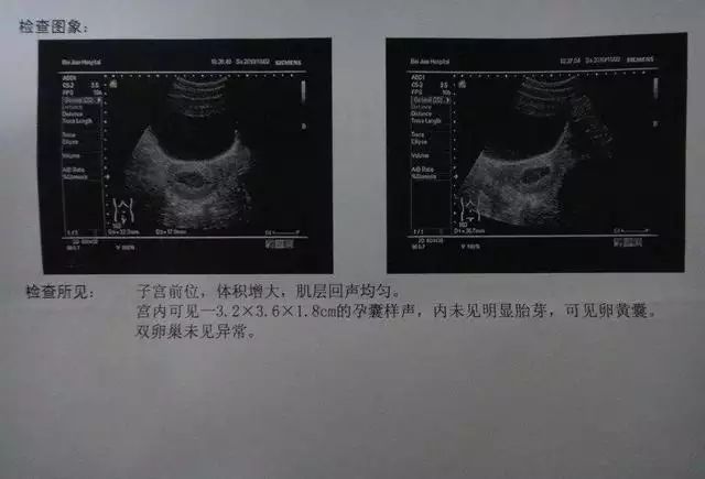 %生男孩肚子圖：懷男孩肚子什麼形狀