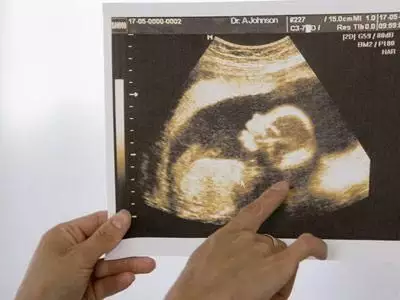 孕囊二個數據是男是女：有沒有孕囊是圓形的生的是男孩的？