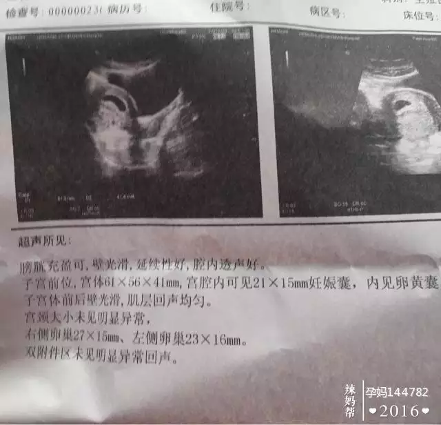 懷孕49天時,孕囊大小是24×23×17,看這三個數據,是還是女寶?