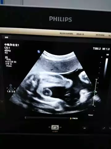 四維彩超胎兒圖片：七個月四維彩超圖片，看下是男孩女孩？