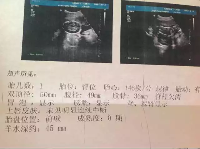 50天孕囊大小對照表：50天的檢查孕囊只有40天大小，是不是出問題了？