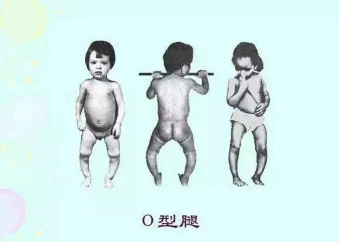 1、佝僂病婚式遺傳圖解:抗d佝僂病屬於什麼遺傳病高中生物