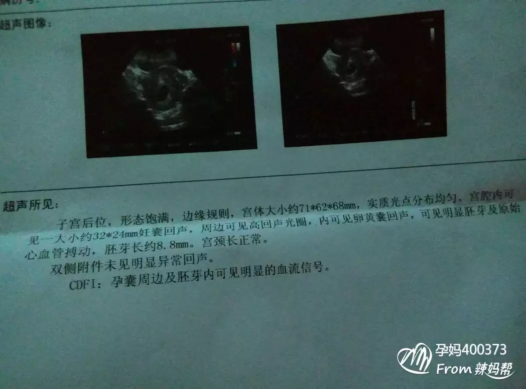 早孕看孕囊看男女准嗎：孕囊形狀看男女准嗎？53×28×20是圓形的嗎