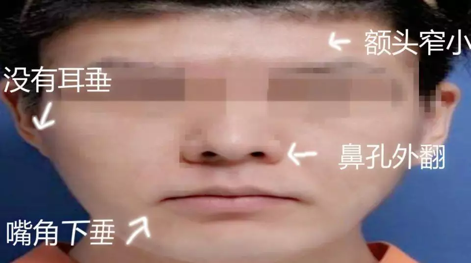 3、女人太陽凹陷的人命苦嗎:太陽穴凹陷不好么？