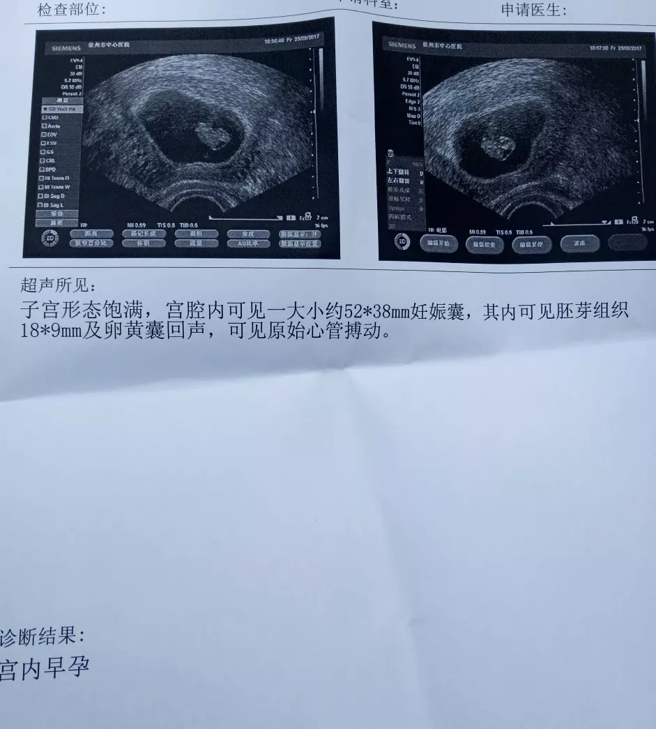 哪種孕囊屬於圓形圖片女孩：請大家幫忙看看，孕囊是長形還是圓形？