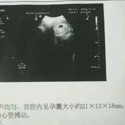 哪種孕囊屬於圓形圖片女孩：孕囊是圓形的 是女孩嗎