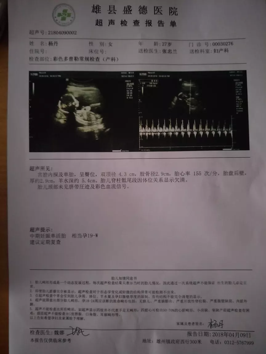 2、無創18三體是負數一定是兒子:無創dna結果負數是男孩還是女孩？