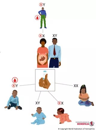 3、血友病是X上隱形基因控制的，女性患此病似乎不能能哦？除非她爸也是血友病，對嗎？