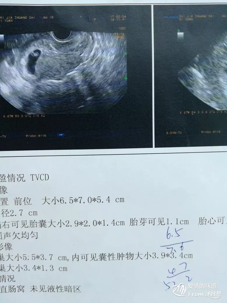 孕囊看男女到底準不準？醫院又不告訴我，用孕囊看男女到底準不準啊？