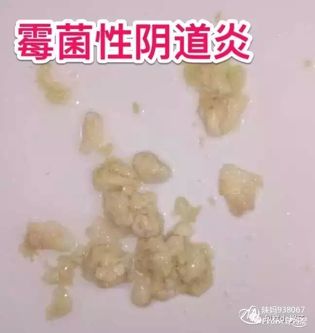 2、和老公就複發黴菌:為什麼我和老公后我會得黴菌性炎