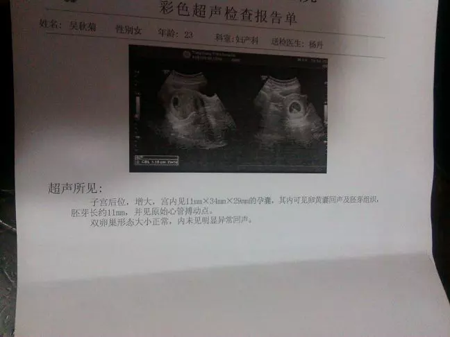 孕囊大小看男女有不準的嗎：孕囊看男女