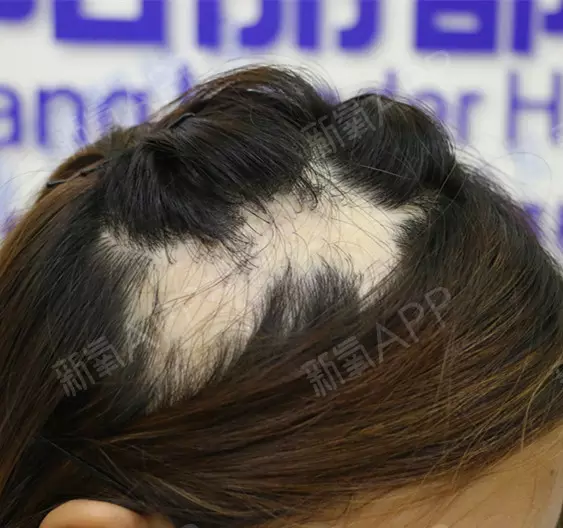 1、剃頭風水上什麼預兆:為什麼會得斑禿