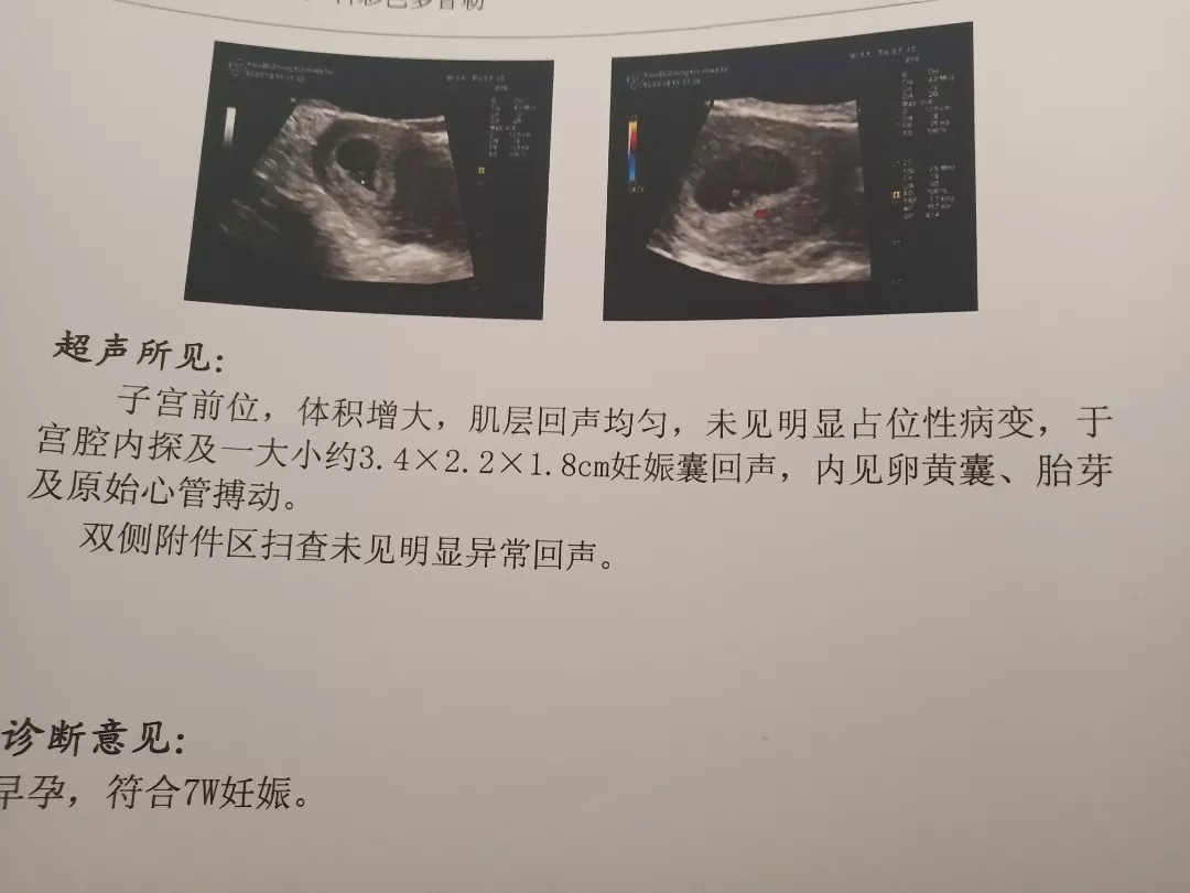 孕囊茄子型是沒發育好嗎：孕囊茄子狀真的就是男孩嗎