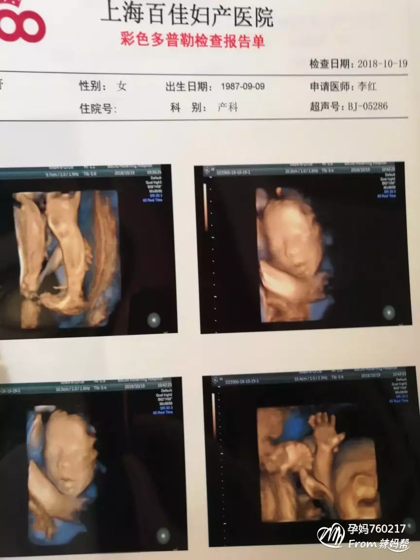 看二胎生男生女是看一胎寶寶兩條腿上的總共線數還是就