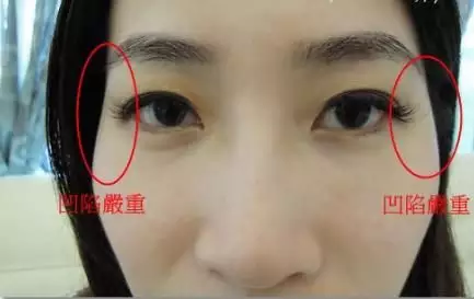 4、夫妻宮凹陷化解:夫妻宮凹陷該怎麼辦