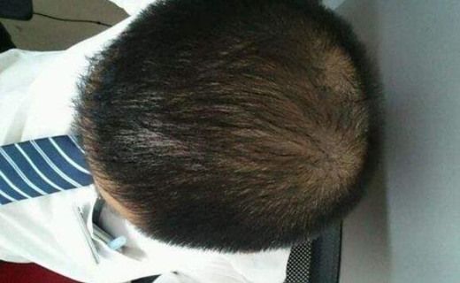 头发稀少的八字特征