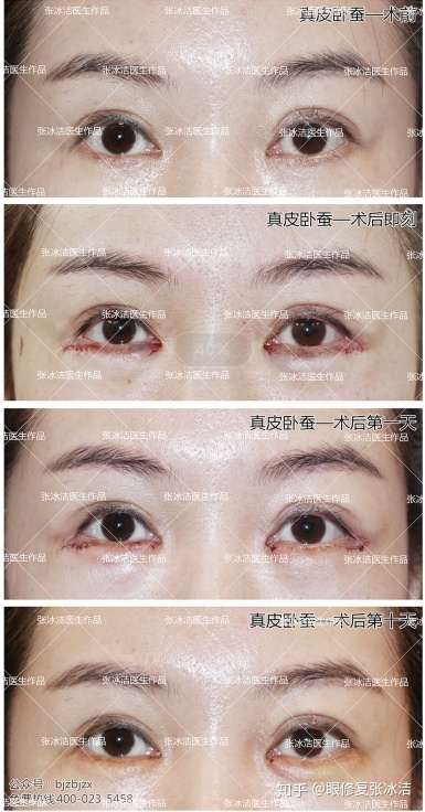 关于卧蚕暗淡无光容易遮挡桃花运势吗的信息