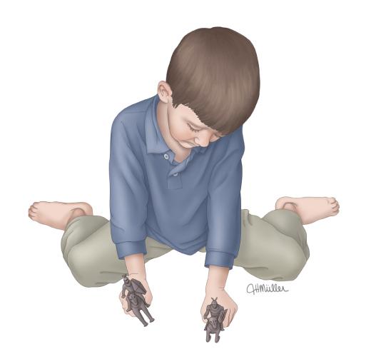 幼儿外八字