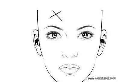 额头有八字纹怎么去除