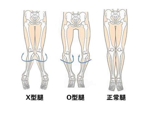 小宝缺钙会造成外八字脚吗 小宝缺钙会造成外八字脚吗