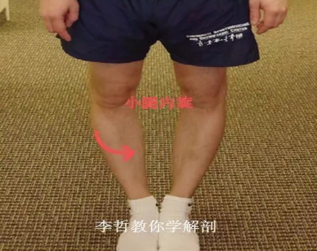 宝宝八字脚怎么纠正 宝宝八字脚怎么纠正