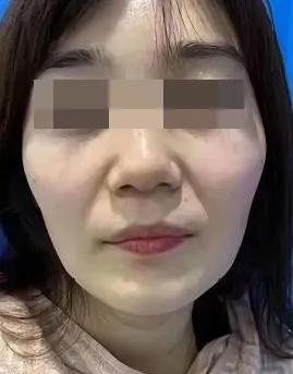 八字笑弧法令纹 八字笑弧法令纹