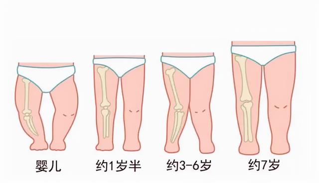 o型腿图片弯八字脚 o型腿图片弯八字脚