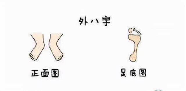 外八字走路的危害 外八字走路的危害
