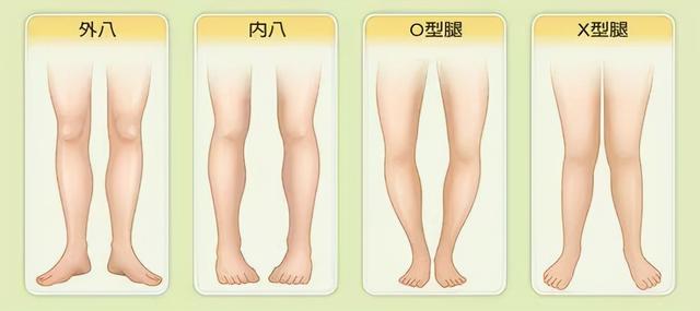 外八字走路的危害 外八字走路的危害
