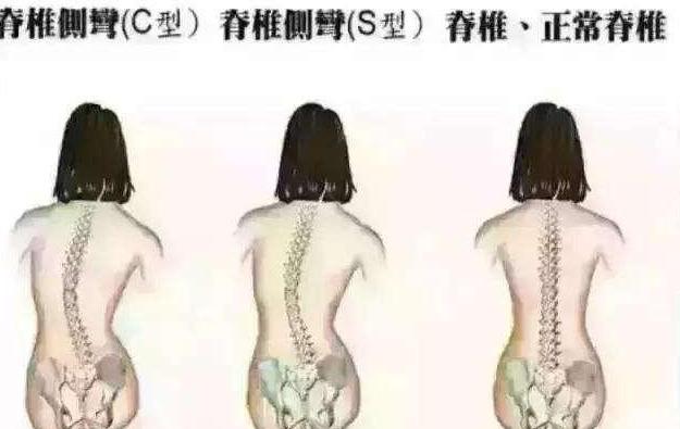 14岁八字钢板阻滞术