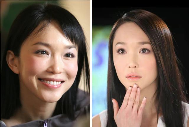 隆鼻后鼻梁的八字印