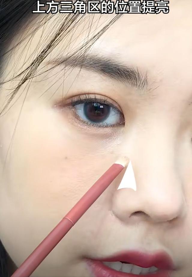 隆鼻后鼻梁的八字印
