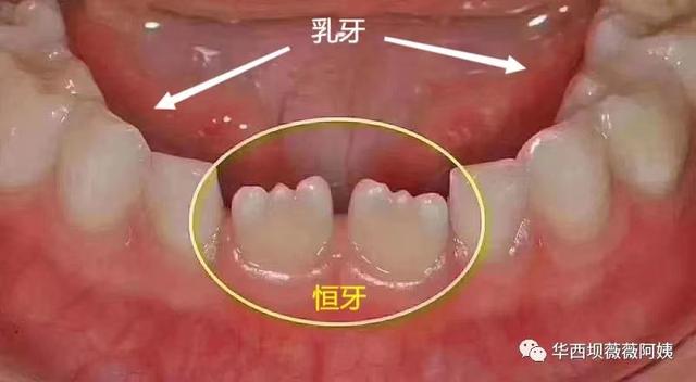 中切牙八字间隙 中切牙八字间隙