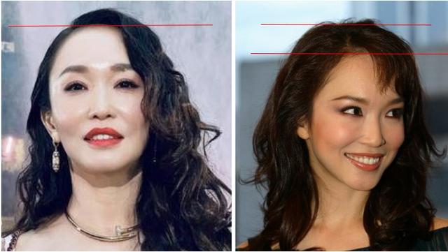 隆鼻后鼻梁的八字印