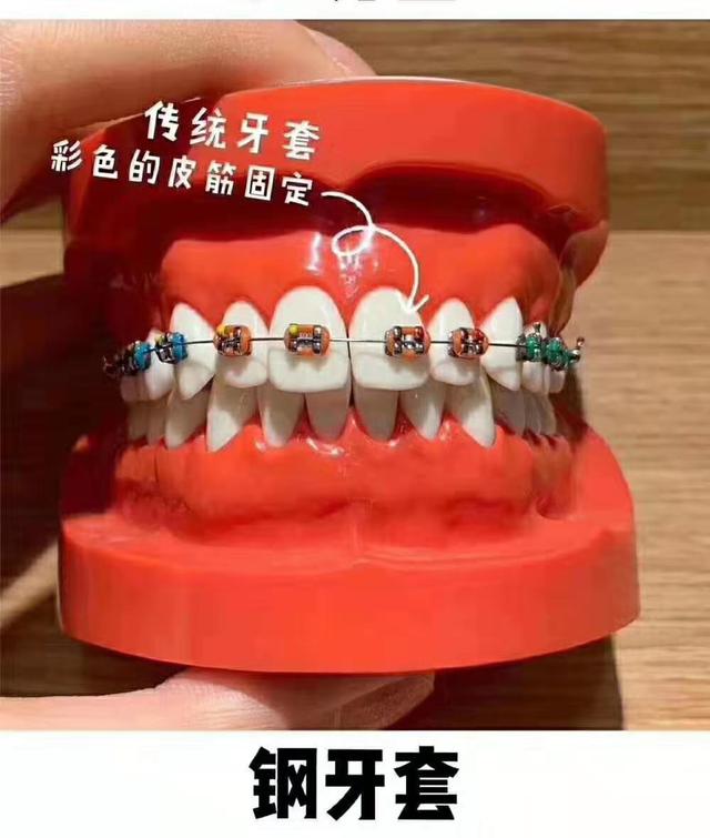 牙套八字结扎是要好了吗