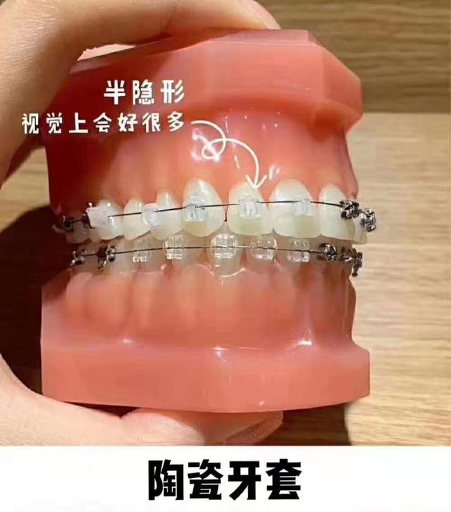 牙套八字结扎是要好了吗
