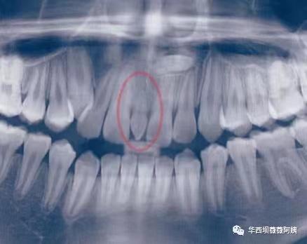 中切牙八字间隙 中切牙八字间隙