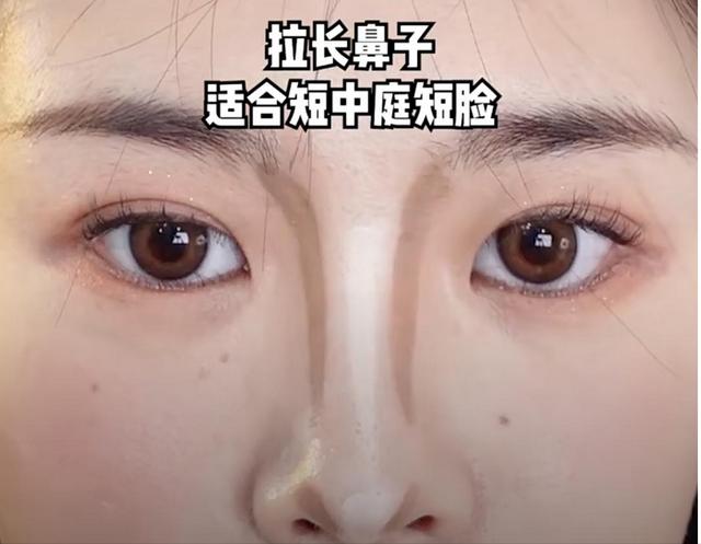 隆鼻后鼻梁的八字印