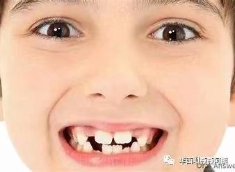中切牙八字间隙 中切牙八字间隙