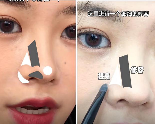 隆鼻后鼻梁的八字印