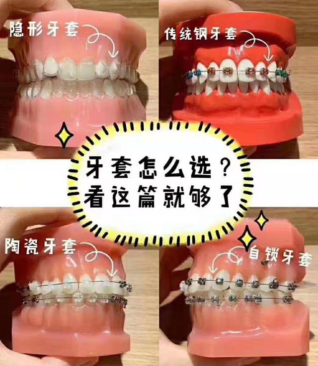 牙套八字结扎是要好了吗