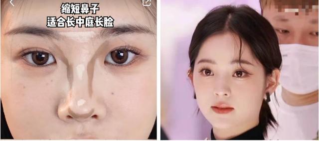 隆鼻后鼻梁的八字印