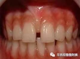中切牙八字间隙 中切牙八字间隙