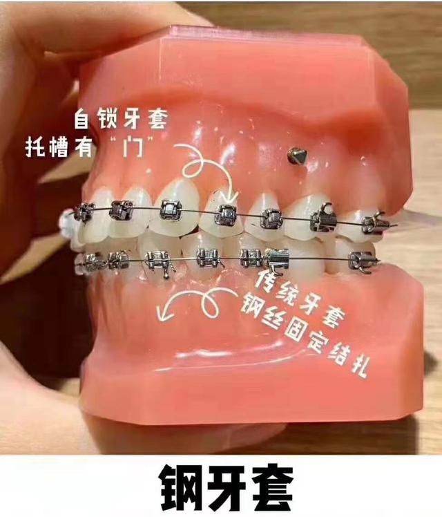 牙套八字结扎是要好了吗