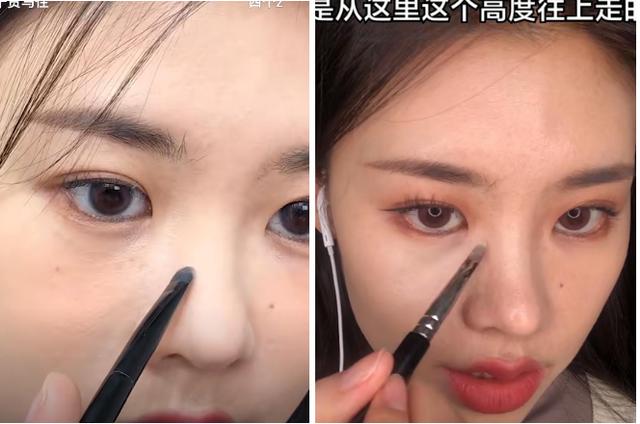 隆鼻后鼻梁的八字印