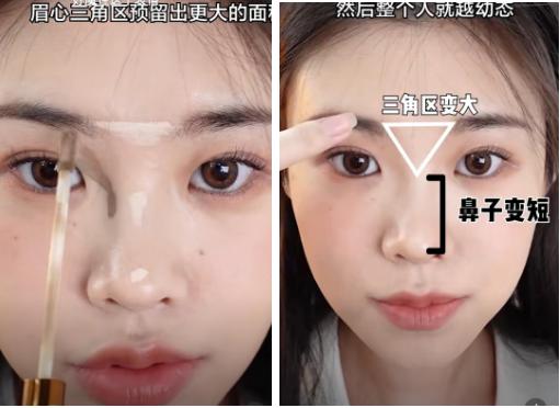 隆鼻后鼻梁的八字印