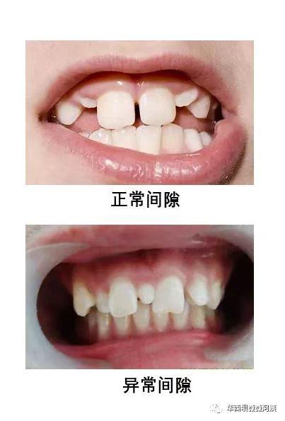 中切牙八字间隙 中切牙八字间隙