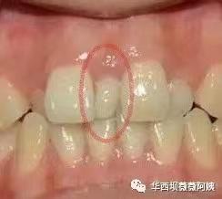 中切牙八字间隙 中切牙八字间隙